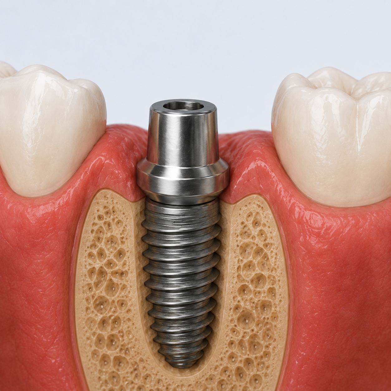 Healing Abutment Attached