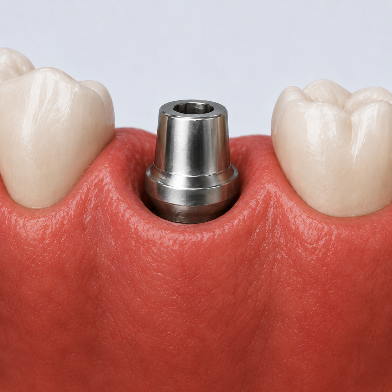 Healing Abutment Exposed